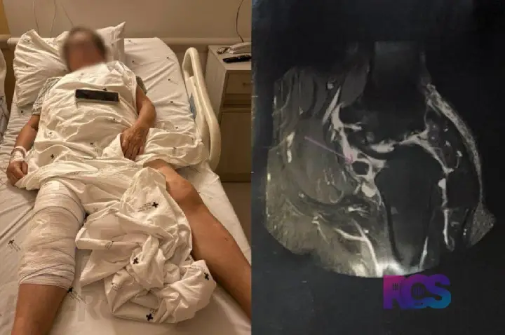Idosa descobre após cirurgia que prótese foi colocada no joelho errado em Curitiba